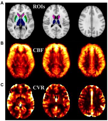 Initiation of combined antiretroviral therapy confers suboptimal beneficial effects on neurovascular function in people with HIV